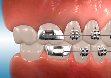 Orthodontic Archwire