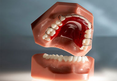 Orthodontic Hawley Retainers