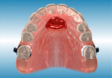Orthodontic Nance Appliance