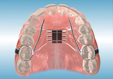 Orthodontic Palatal Expander (RPE)
