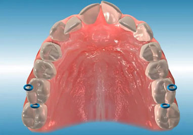 Orthodontic Seperators