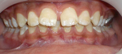 Orthodontic Spacing
